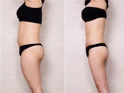 腿部吸脂需要花多少钱