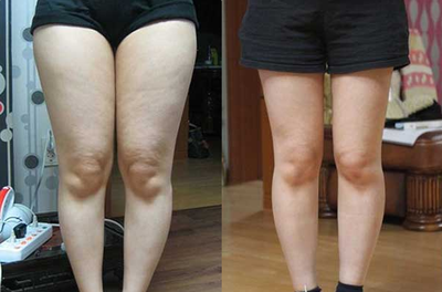 腿部吸脂术后的护理