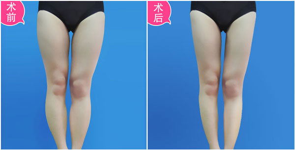 瘦腿一般多少钱