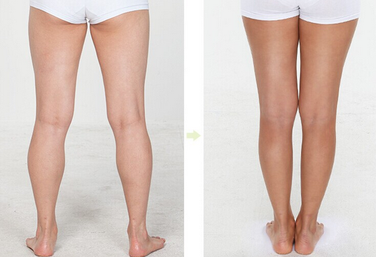 大腿吸脂后效果不明显 大腿吸脂后效果不明显