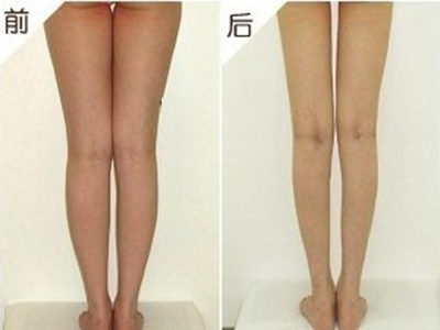 大腿溶脂手术多少钱