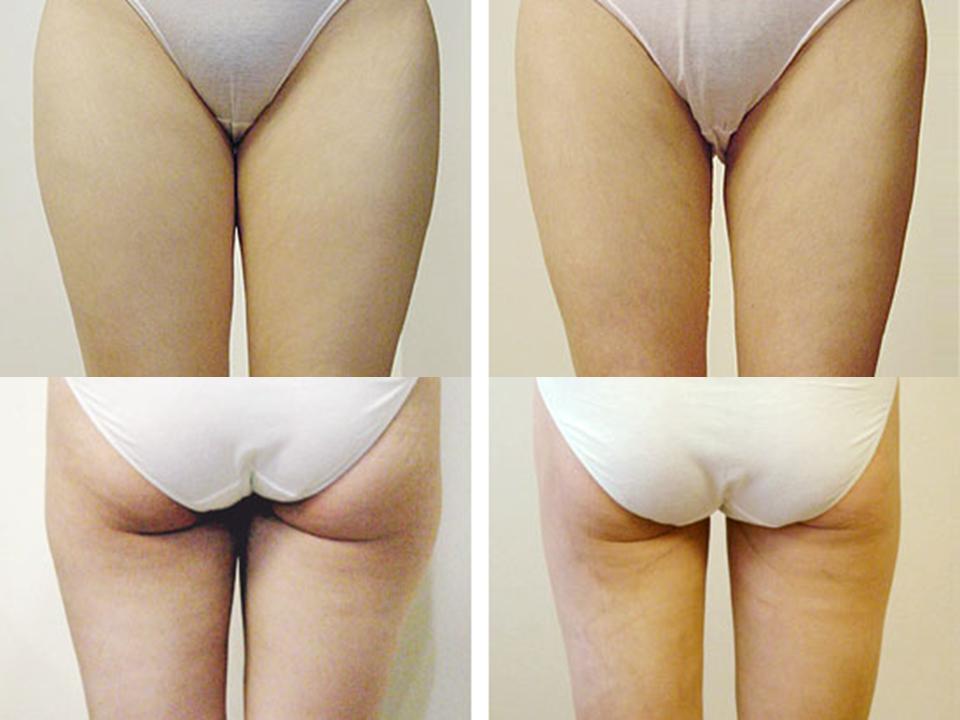 大腿抽脂腿会有后遗症吗 大腿抽脂腿会有后遗症吗