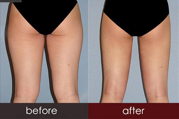 抽脂大腿屁股 抽脂大腿屁股