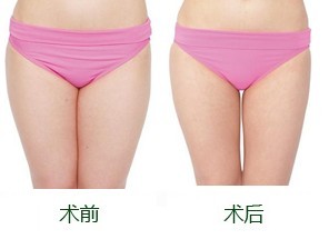 大腿抽脂多久正常不痛 大腿抽脂多久正常不痛