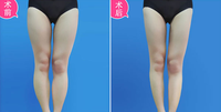 大腿环吸脂注意事项有哪些 大腿环吸脂注意事项有哪些