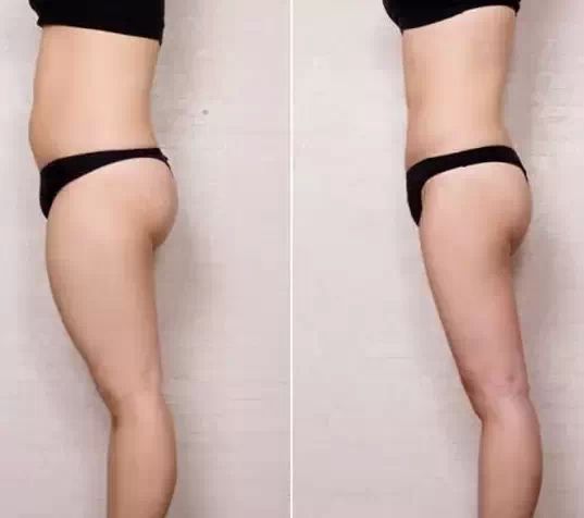 抽脂瘦腿的准备及术后护理 抽脂瘦腿的准备及术后护理