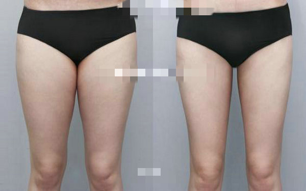 腿部抽脂术多少钱?