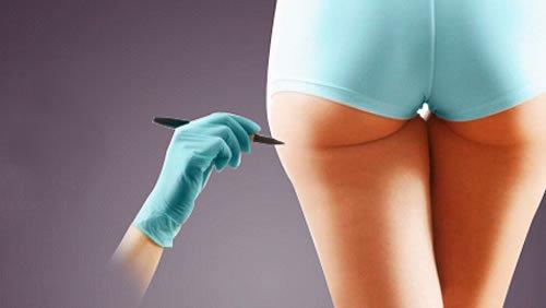 大腿吸脂多久可以运动 大腿吸脂多久可以运动