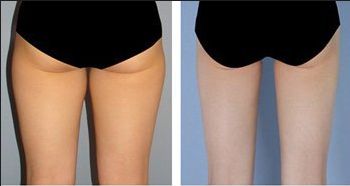 大腿抽脂热敷还是冷敷