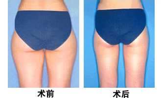 大腿抽脂有什么危害吗 大腿抽脂有什么危害吗