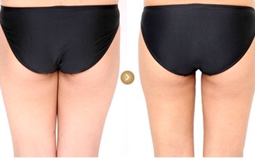 大腿吸脂减肥 大腿吸脂减肥