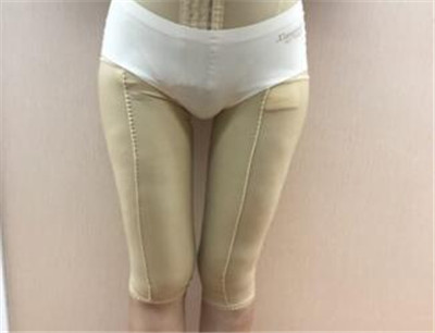 腿部吸脂7天效果恢复图 腿部吸脂7天效果恢复图