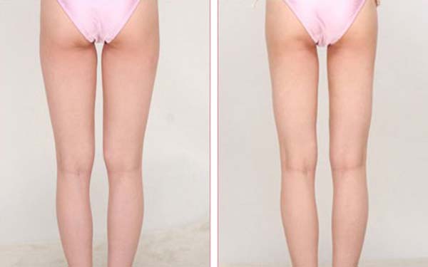 韩式大腿吸脂方法是什么呢