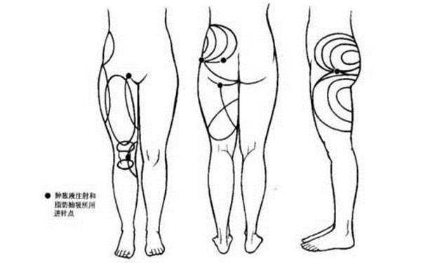 大腿吸脂术后多久能恢复弹性 大腿吸脂术后多久能恢复弹性