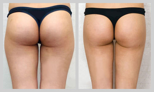 大腿抽脂恢复过程图
