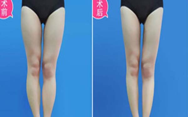 韩式分层大腿吸脂术效果好不