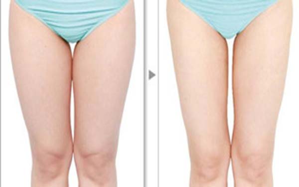 韩式分层吸脂有什么优势