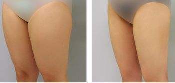 大腿环吸后多久消肿