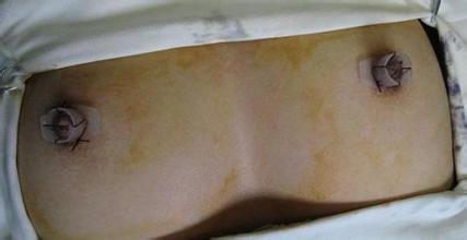 乳头整形安全吗 乳头整形安全吗