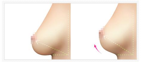 哺乳后乳房下垂缩小 哺乳后乳房下垂缩小