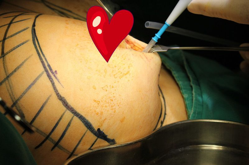 奥美定丰乳取出价格 奥美定丰乳取出价格