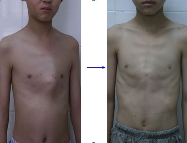 胸肌不对称矫正方法 胸肌不对称矫正方法