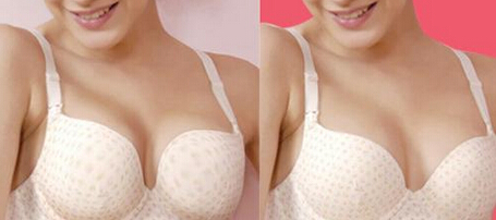 上海注射隆胸修复价格是多少钱 上海注射隆胸修复价格是多少钱