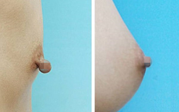 乳头矫正手术什么年龄好 乳头矫正手术什么年龄好