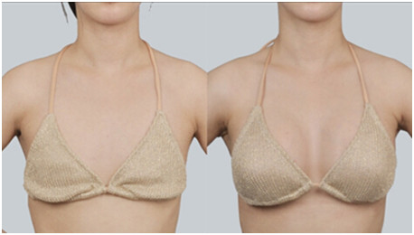 乳房手术后多久能恢复 乳房手术后多久能恢复