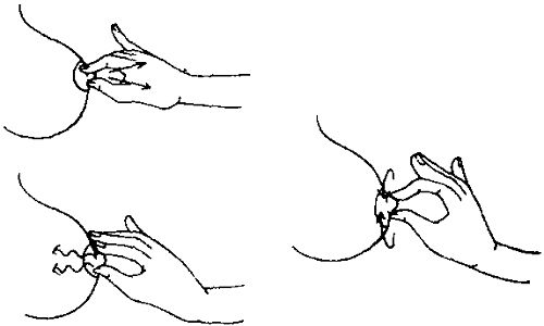 乳头内陷矫正注意事项 乳头内陷矫正注意事项