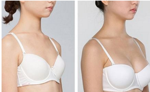 乳房下垂矫正多少钱?