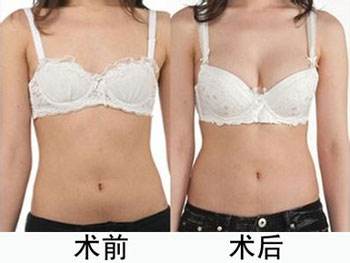 垂乳上提术的准备及并发症 垂乳上提术的准备及并发症