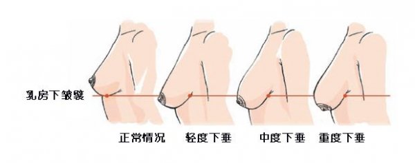 不同乳房下垂的不同矫正办法