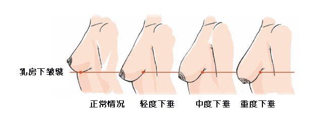 不同乳房下垂的不同矫正办法 不同乳房下垂的不同矫正办法