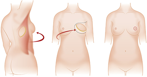 做乳房再造的价格