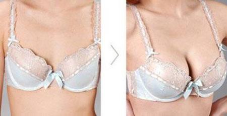 广东自体组织乳房再造术注意什么