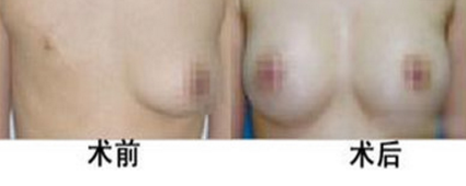 乳房再造为什么需要选准时期