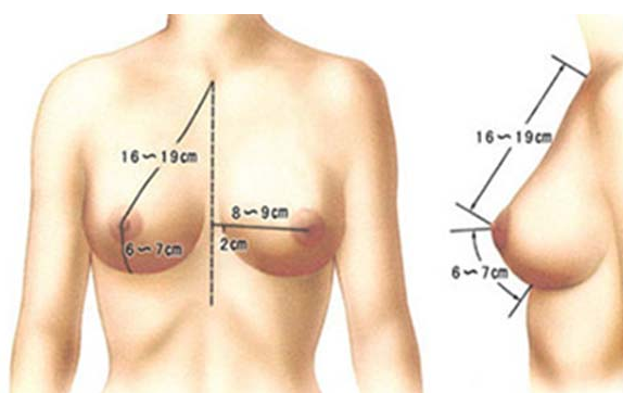 北京乳房再造术安全吗