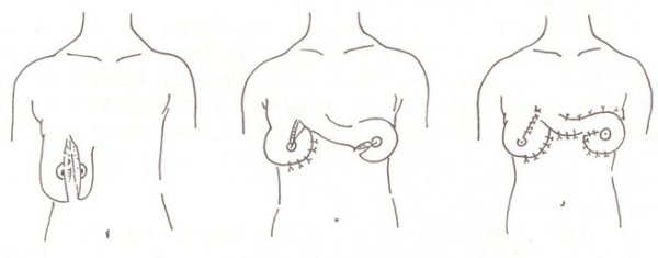 乳房缺失了应该怎么办