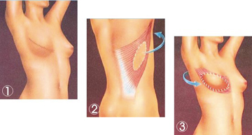 乳房再造术效果安全吗