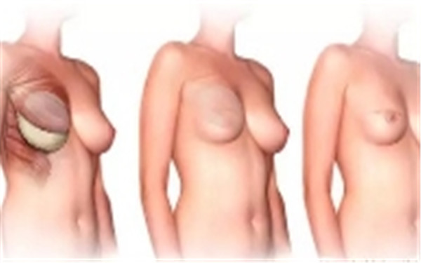 乳房再造术的术前注意事项