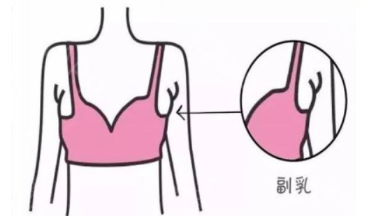 女人有副乳怎么办 女人有副乳怎么办