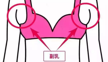 腋下有副乳怎么办 腋下有副乳怎么办
