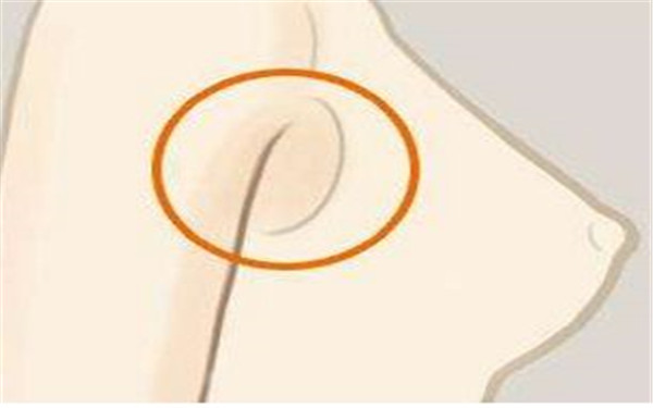 副乳手术疼吗 副乳手术疼吗