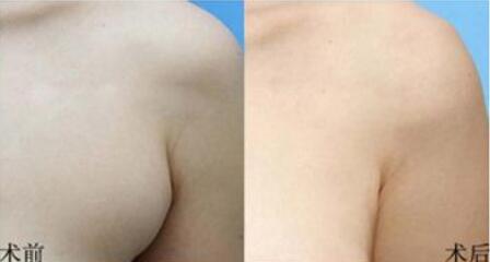 副乳吸脂手术恢复多久
