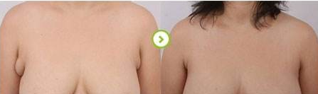 副乳吸脂手术有后遗症吗