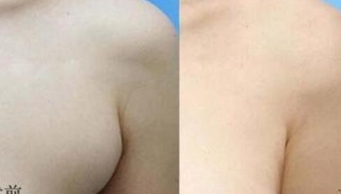 副乳手术哪家好 副乳手术哪家好