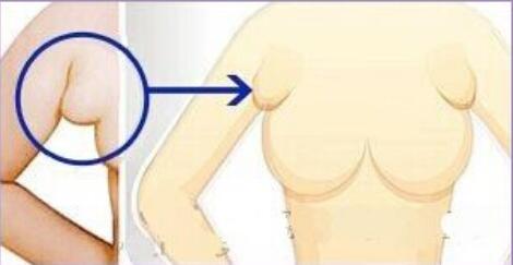 副乳吸脂手术疼吗