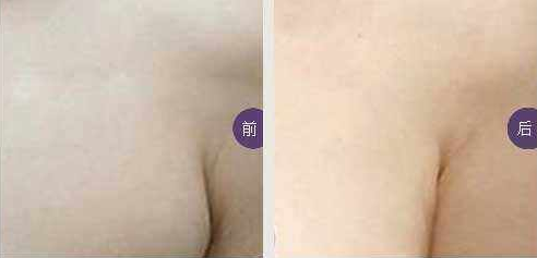 副乳切除怎么做