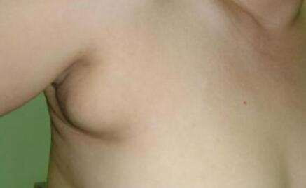 副乳手术效果 副乳手术效果